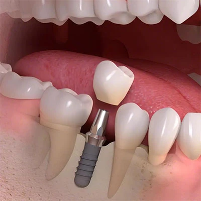 Tish implantlari qancha davom etadi?